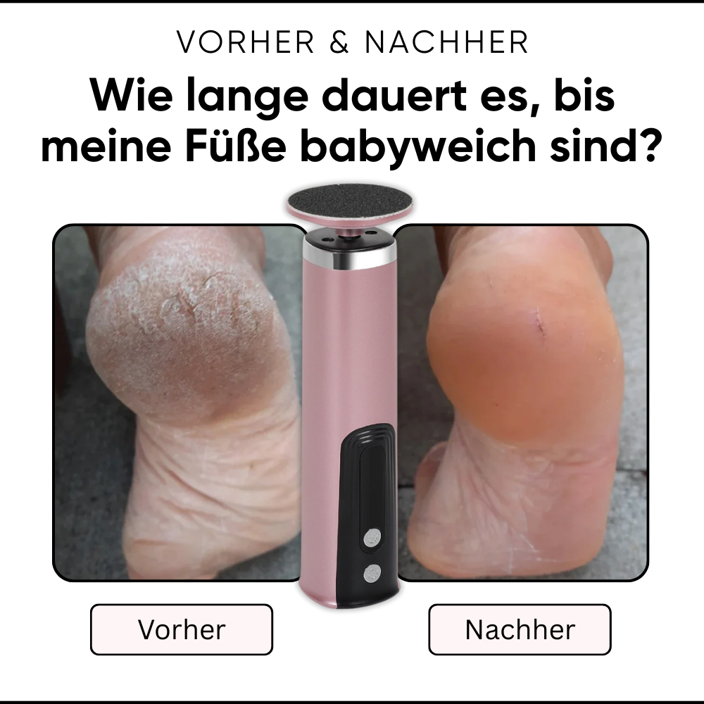 Limaor™ Elektrischer Hornhautentferner