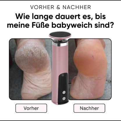 Limaor™ Elektrischer Hornhautentferner